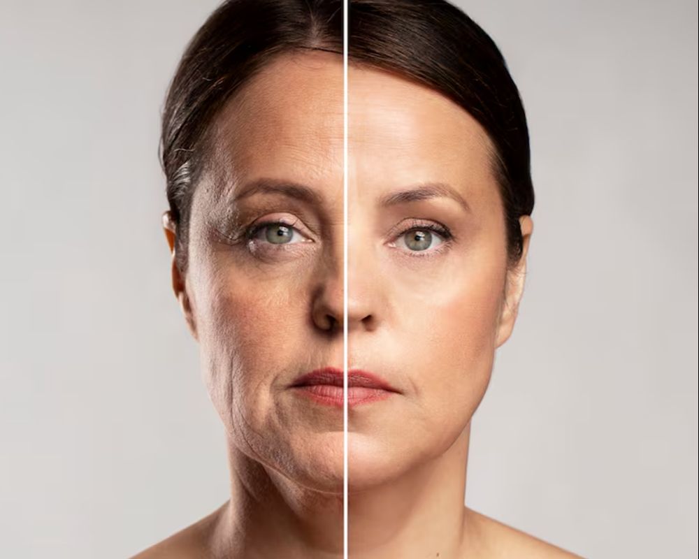 Sculptra Collagen Stimulator